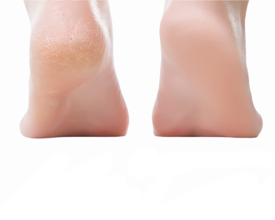 Rechargeable Electric Foot Callus Remover